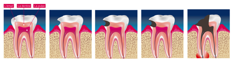 carie-dentaire