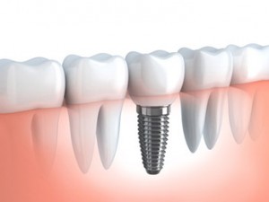 IMPLANT